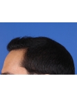 After Hair Transplant Front